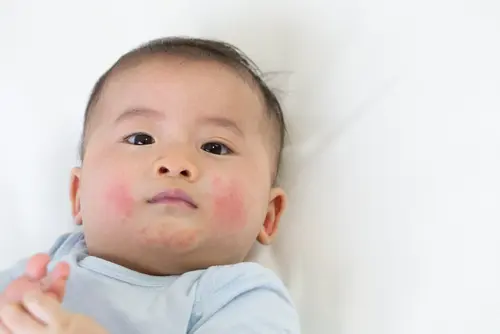 Common dermatological condition requiring dermatology specialist care